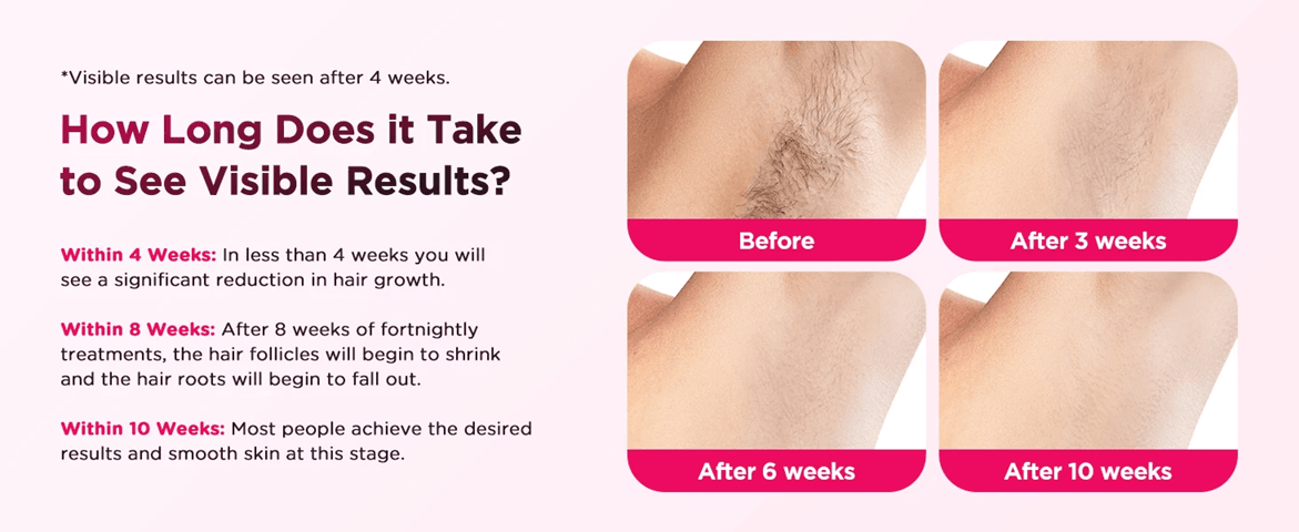 SilkBeam 990000 Flash IPL Hair Removal Device For Face And Body 4