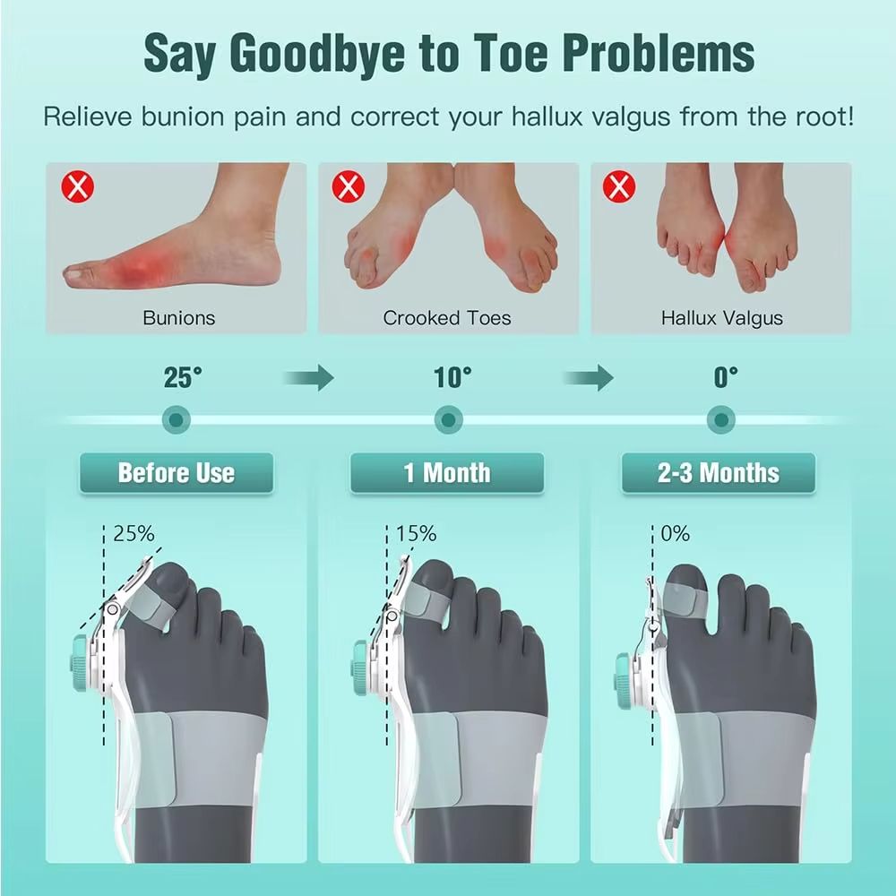 Adjustable Bunion Corrector  Big Toe Straightener And Hallux Valgus Support With Rotating Alignment 2