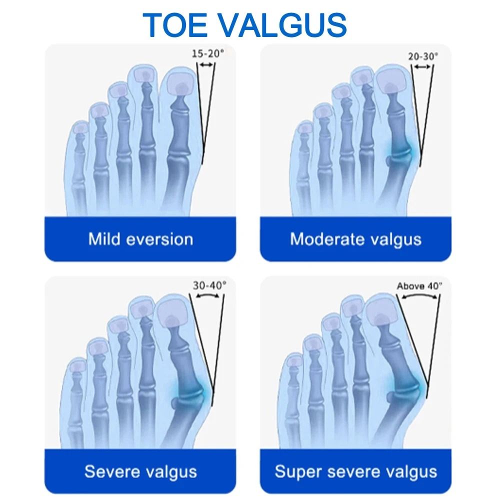 Bunion Splint Big Toe Straightener Orthopedic Foot Corrector For Hallux Valgus Pain Relief 1