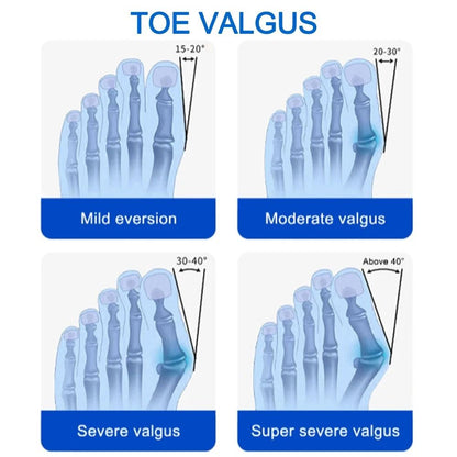 Bunion Splint Big Toe Straightener Orthopedic Foot Corrector For Hallux Valgus Pain Relief 1