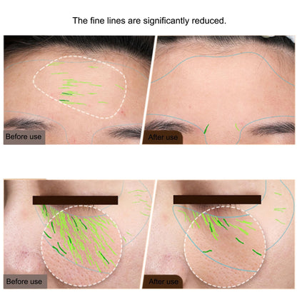 EMS RF Facial And Body Skin Tightening Device 2