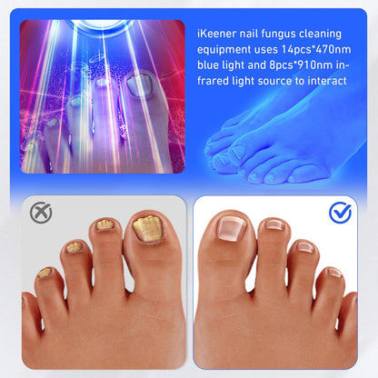 Onychomycosis Infrared Light, Wireless Nail Fungus Laser Device for Toenails, Blue Light Anti Fungal Laser Equipment