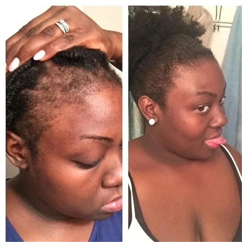 Rosemary Onion Hair Growth Shampoo With AntiHair Loss Spray  Fast Hair Regrowth In 7 Days 4
