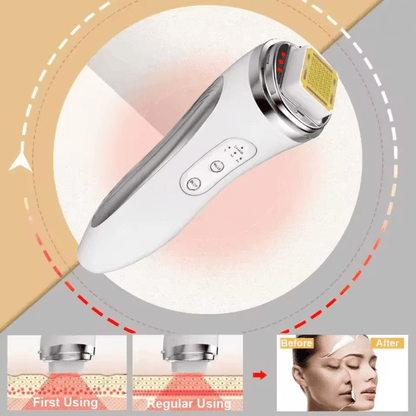 RF Facial Lifting Machine High Frequency Skin Tightening And Wrinkle Removal Device 1