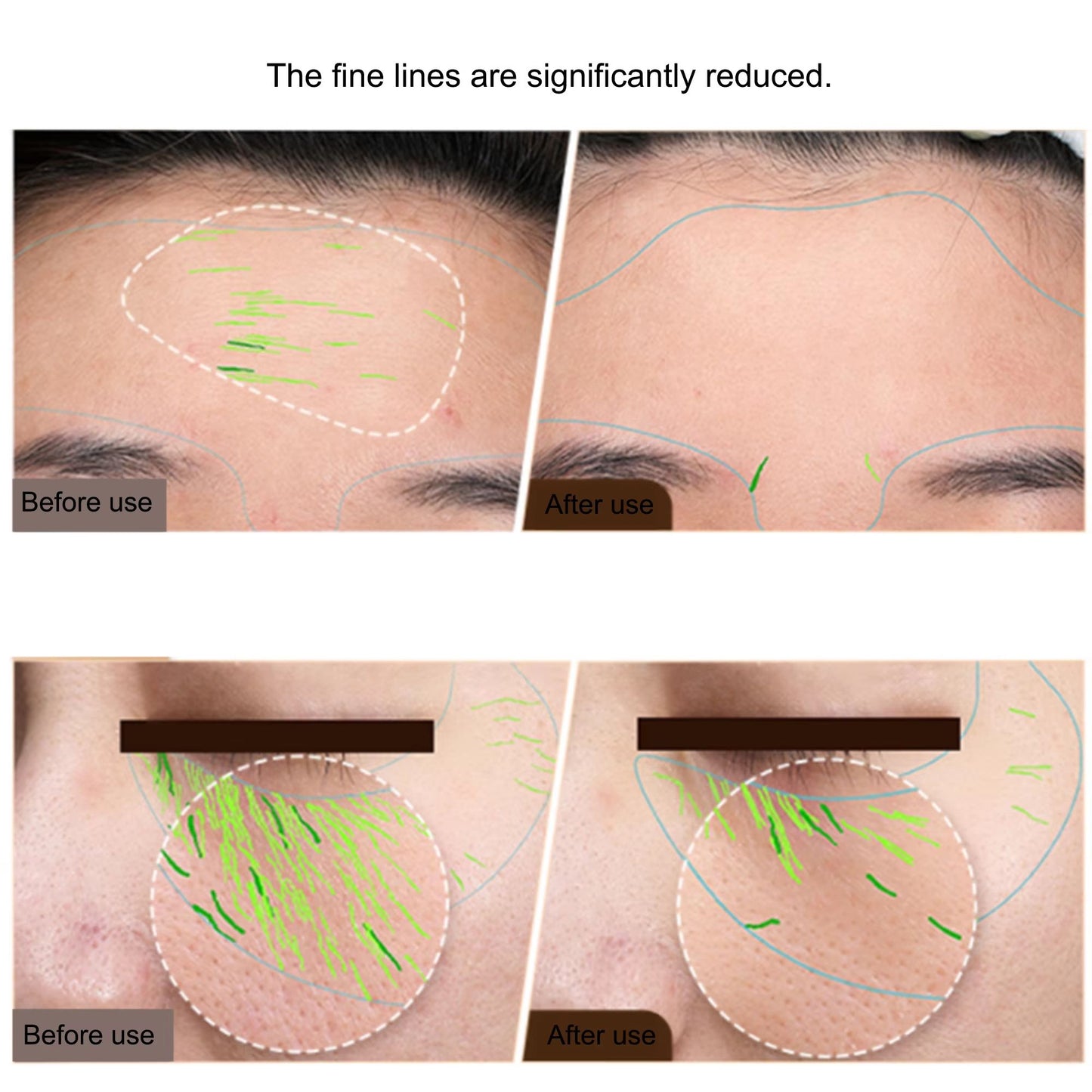 EMS RF Skin Tightening Device  Professional Face Lifting  AntiAging Beauty Machine For Home Use 1