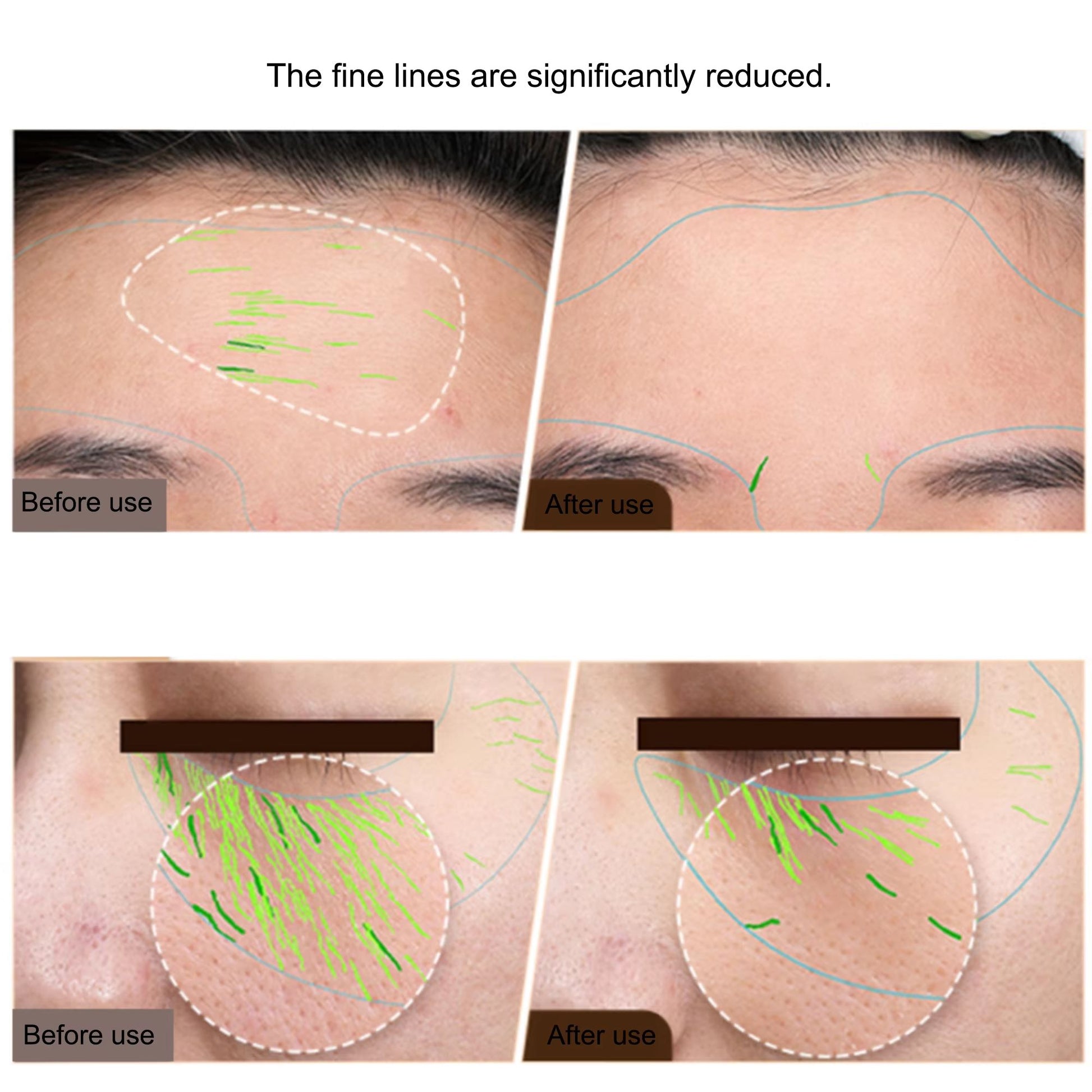 EMS RF Skin Tightening Device  Professional Face Lifting  AntiAging Beauty Machine For Home Use 1