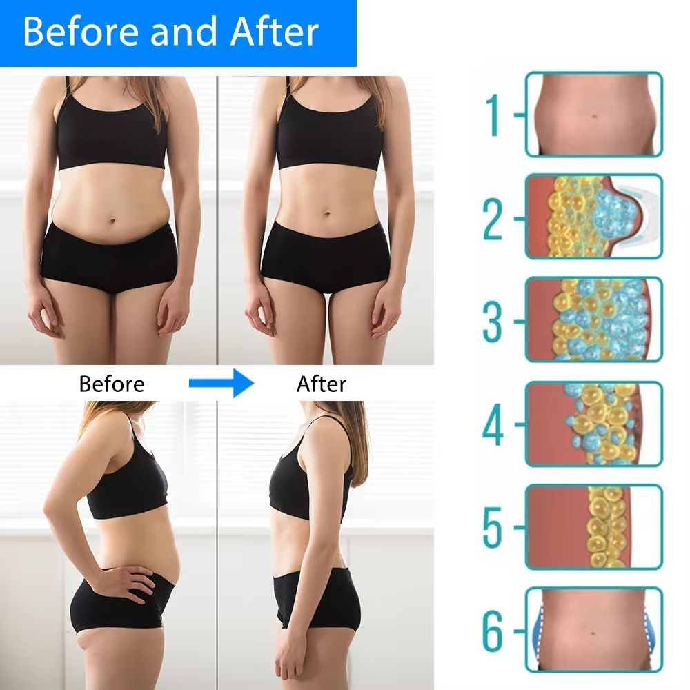 Cryotherapy Fat Freezing Machine  Cold Therapy Body Slimming Massager For Abdominal Fat Reduction A 4