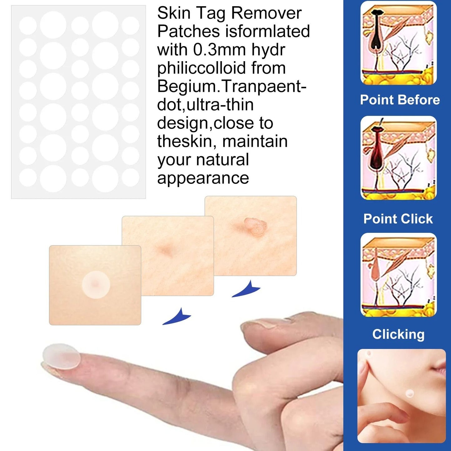 2 In 1 Painless Auto Skin Tag And Mole Remover Kit 2