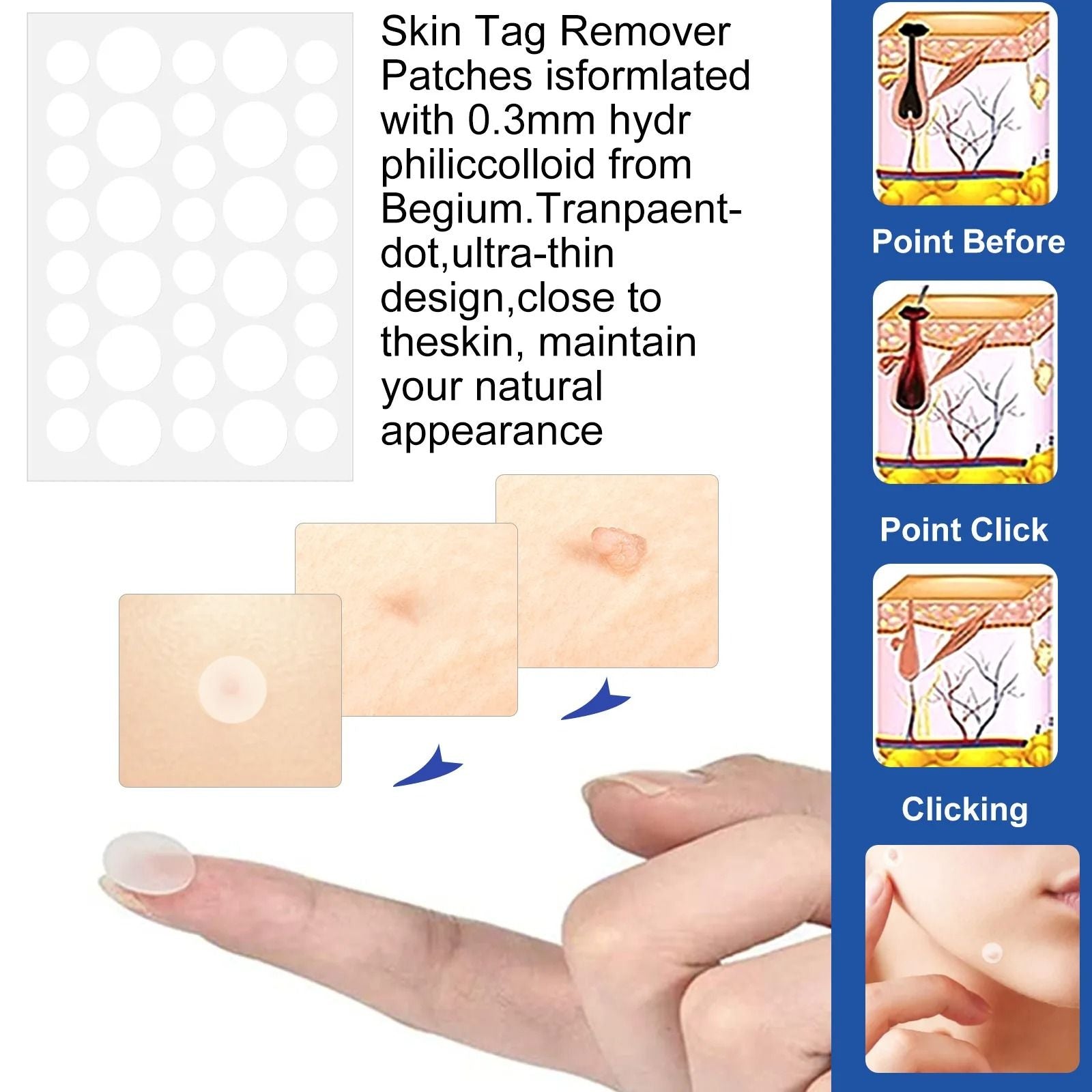 2 In 1 Painless Auto Skin Tag And Mole Remover Kit 2