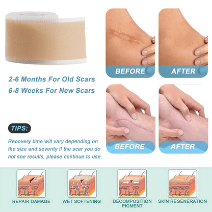 Medical Grade Silicone Scar Sheet Painless Effective Scar Repair Tape Silicone Scar Tape For Surgic 3