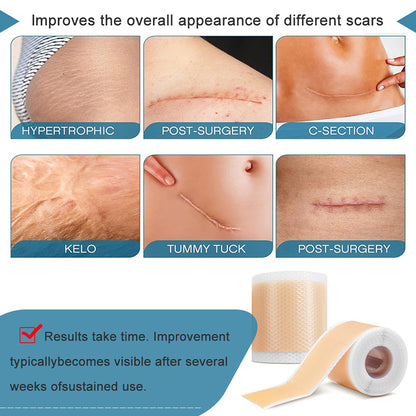 Medical Grade Silicone Scar Sheet Painless Effective Scar Repair Tape Silicone Scar Tape For Surgic 5