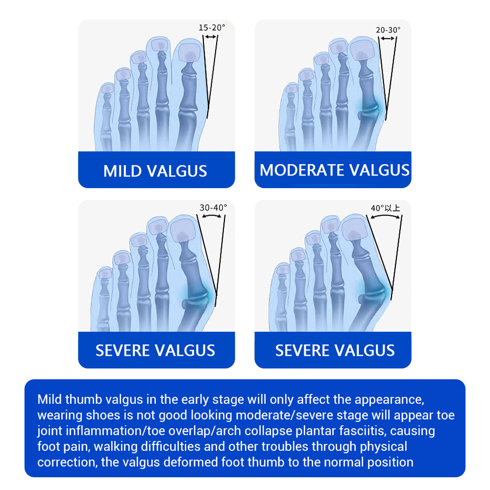 Toe Separator, Bunion Corrector, Foot Hallux Valgus Braces, Toe Straightener, Foot Care Tool, Bone Adjuster