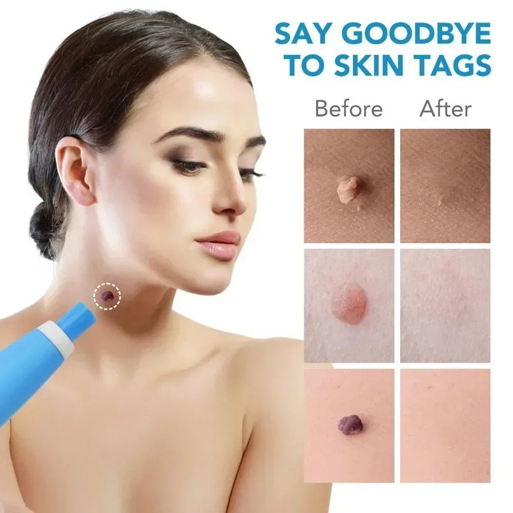 2in1 Skin Tag And Mole Removal Tool Kit 3