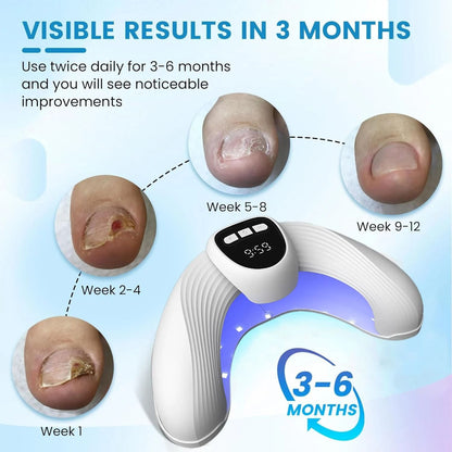 Laser Nail Fungus Treatment Device For Healthy Toenails And Fingernails 2